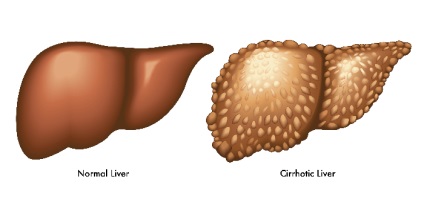 Ciroza hepatică