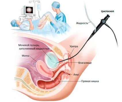 Cistita după naștere la femei, dezvoltarea și eliminarea bolii