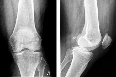 Deformarea artrozei, centrul osteoporozei