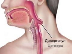 Nyelőcső diverticulumok - tünetek és kezelés; Zenker diverticulum a nyelőcső