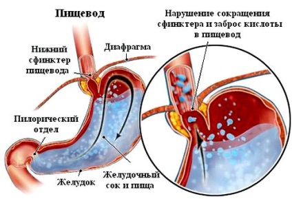 Duodeno reflux gastric