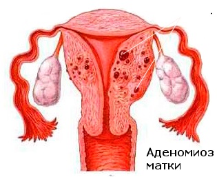 Endometrioza și adenomioza reprezintă diferența