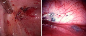 Endometrioza și adenomioza reprezintă diferența