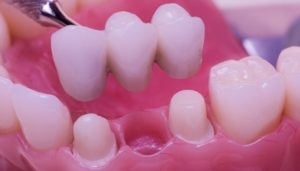 Etapele protezelor dentare, sănătoase