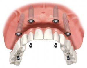 Igiena cavității orale după implantarea dinților