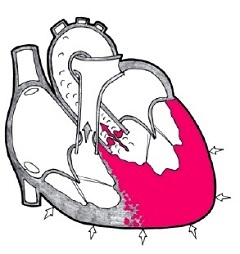 Hipertrofia ventriculului stâng al tratamentului inimii, semne