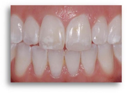 Hypoplasia diagnosticului și tratamentului smalțului dinților