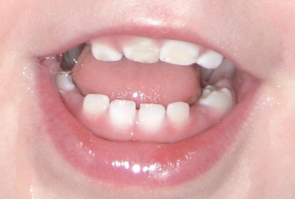 Hypoplasia diagnosticului și tratamentului smalțului dinților