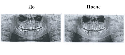 Implantologie - policlinică stomatologică №62