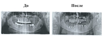 Implantologie - policlinică stomatologică №62