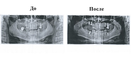 Implantologie - policlinică stomatologică №62