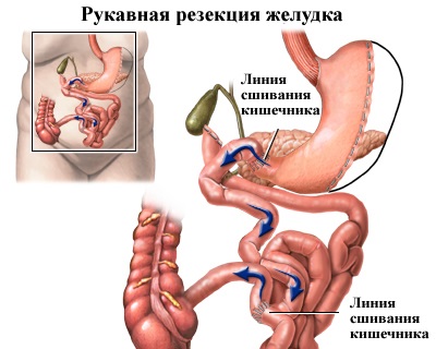 Melyek a műtéti fogyás módszerek - zozhnik