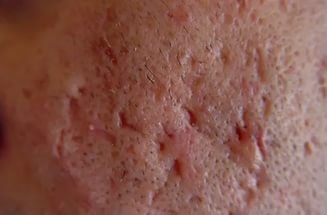 Cum sa scapi de metode de cicatrizare acnee si retete