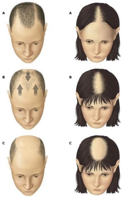 Cum să opriți căderea părului și restaurați metodele de creștere a părului pentru tratarea alopeciei - stabilirea stării de sănătate