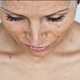 Cum să eliminați petele de pe piele după arsurile solare