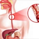 Reflux oesophagitis hurutos tünetek és a kezelés, okok, előfordulás