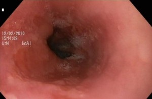 Catarrhal esofagita de reflux simptome și de tratament, cauzele de dezvoltare, scurgeri