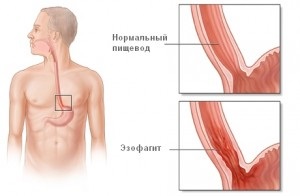 Catarrhal esofagita de reflux simptome și de tratament, cauzele de dezvoltare, scurgeri