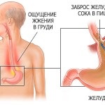 Catarrhal esofagita de reflux simptome și de tratament, cauzele de dezvoltare, scurgeri