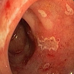 Catarrhal esofagita de reflux simptome și de tratament, cauzele de dezvoltare, scurgeri