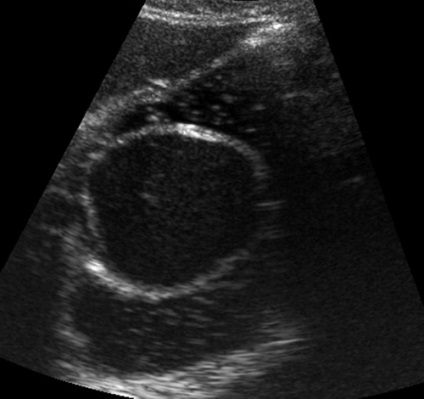 Diagnosticarea ultrasunetelor chisturilor duplicative intestinale și comparații morfologice -