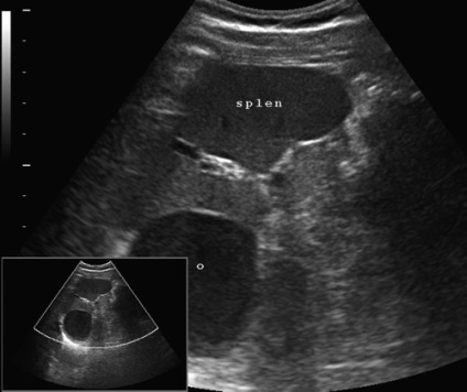 Diagnosticarea ultrasunetelor chisturilor duplicative intestinale și comparații morfologice -