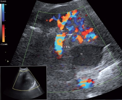 Diagnosticarea ultrasunetelor chisturilor duplicative intestinale și comparații morfologice -