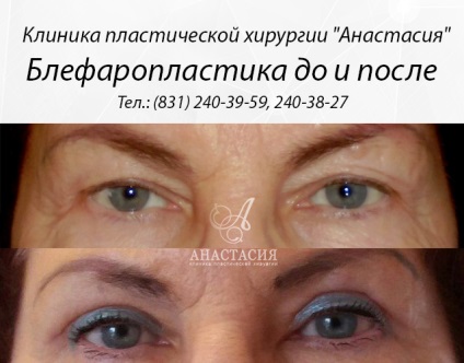 Clinica de anastasie - blefaroplastie (plasticul pleoapelor superioare și inferioare)