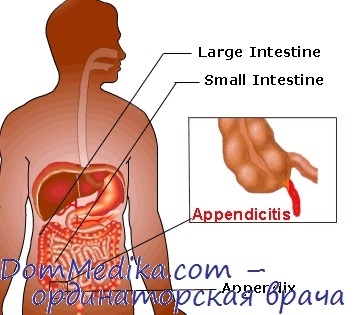 Clinica de apendicită acută