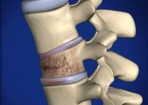 Fractura de fractură a fracturilor vertebre - simptome, diagnostic și tratament