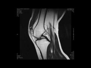 Tomografia computerizată a genunchiului