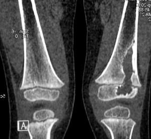 Tomografia computerizată a genunchiului