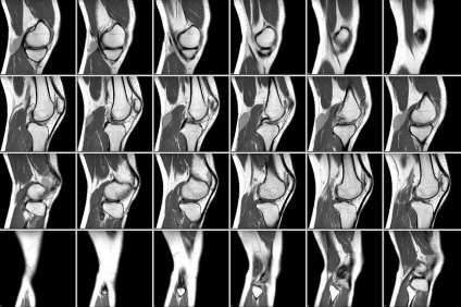 KT costul articulației genunchiului, ceea ce arată studiul