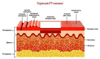 Descriere peeling cu laser, contraindicații, costuri