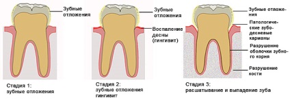 Tratamentul gingivitei, simptome, cauze, costuri