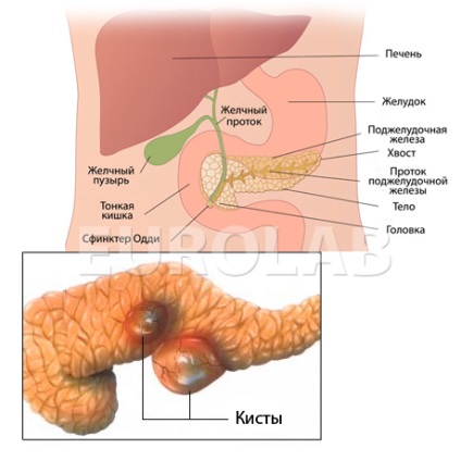 Tratamentul chistului pancreas - portal medical eurolab