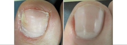 Tratamentul onychomycosis (unghiile ciuperci) în clinici es Astrakhan