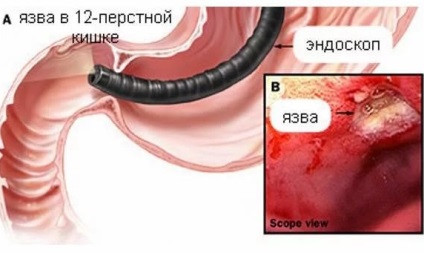 Tratamentul ulcerelor gastrice și duodenale - simptome și semne ulcer gastrice