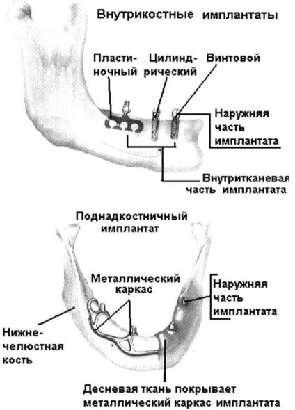 Curs 30 materiale pentru chirurgia reconstructivă a feței și pentru implanturile dentare