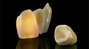 Ceramica ceramica coroane dentare in clinica roott