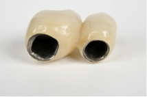 Ceramica ceramica coroane dentare in clinica roott