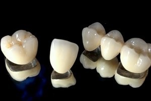 Ceramica ceramica coroane dentare in clinica roott