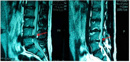 Eliminarea microchirurgicală a herniilor disc intervertebrale, centrul patologiei coloanei vertebrale a cormoranului