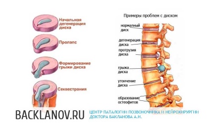 Eliminarea microchirurgicală a herniilor disc intervertebrale, centrul patologiei coloanei vertebrale a cormoranului