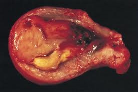 Myomii uterului - postmenopauza