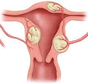 Myoma cu menopauză - nu la fel de înfricoșător, cum sună!