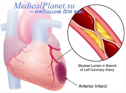 Modelarea infarctului miocardic