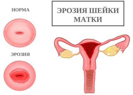 Endometrioza se poate dezvolta in cancer, asa cum este transmis