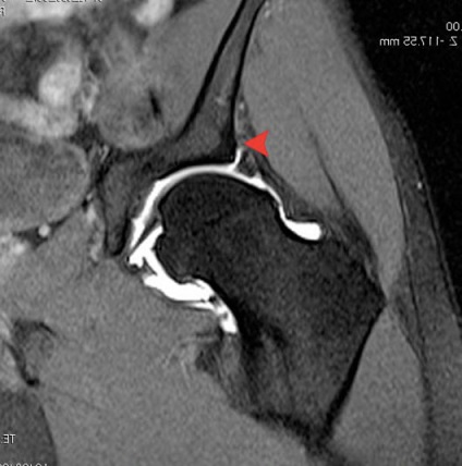 MRI A csípőízület (csípőízület lehetővé teszi) MRI a csípő