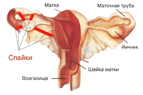 Obstrucția tuburilor uterine